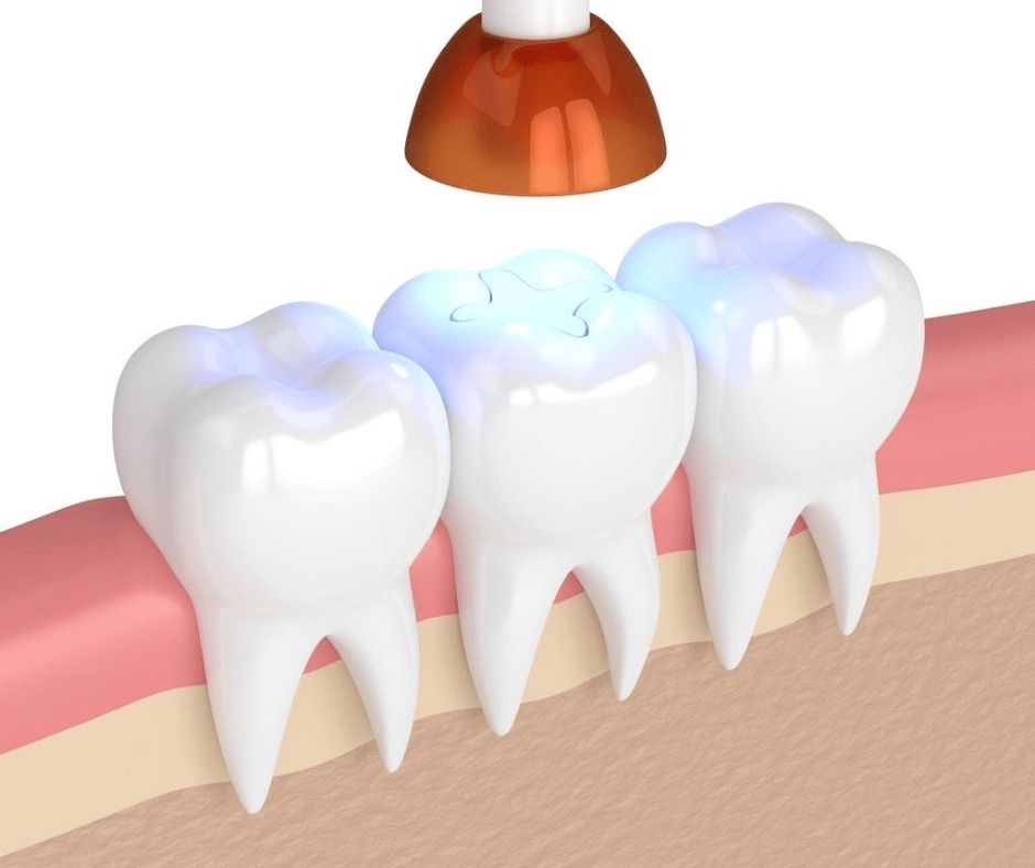 hàn răng 49k Yenle Dental